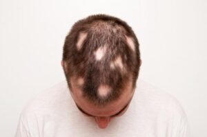 Read more about the article Understanding Alopecia: Causes, Symptoms, and Treatment Methods