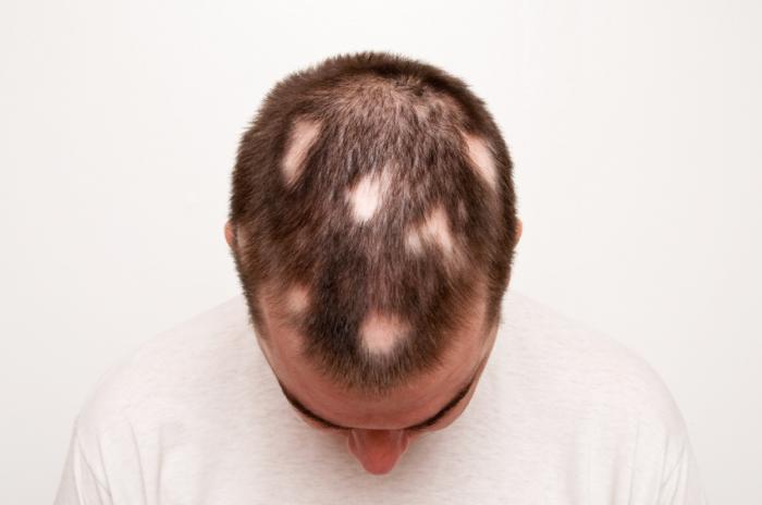 Read more about the article Understanding Alopecia: Causes, Symptoms, and Treatment Methods