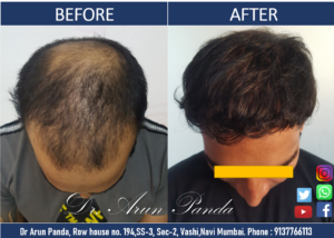 Read more about the article Hair Transplant Patient from Mumbai sharing his experience and Incredible Hair Transplant Results