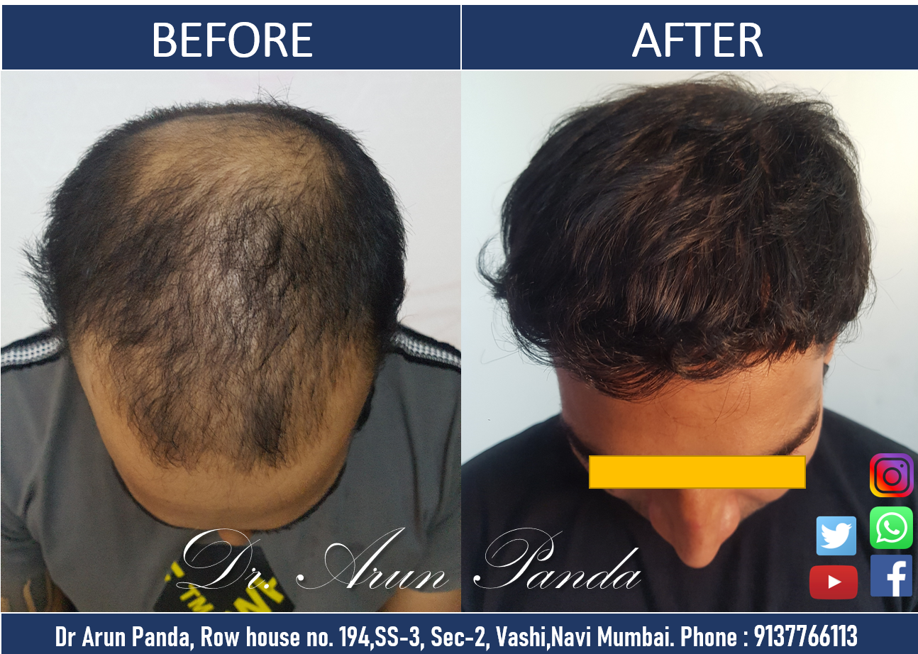 Read more about the article Hair Transplant Navi Mumbai Patient’s 100% Success Rate