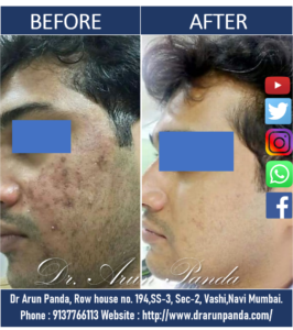 Read more about the article Acne Treatment & Acne Scars Removal in Navi Mumbai