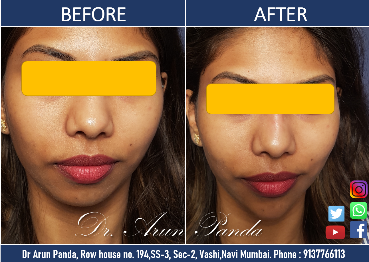 Read more about the article CHIN AND JAW LINE ENHANCEMENT TREATMENT IN NAVI MUMBAI