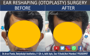 Read more about the article Ear Reshaping surgery in Navi Mumbai