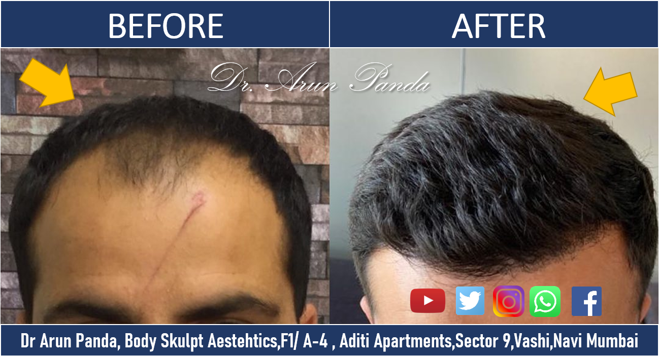 Read more about the article High-density Hair Transplantation Navi Mumbai