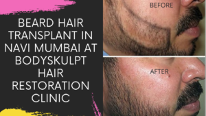 Read more about the article BEARD HAIR TRANSPLANT IN NAVI MUMBAI AT BODYSKULPT HAIR RESTORATION CLINIC
