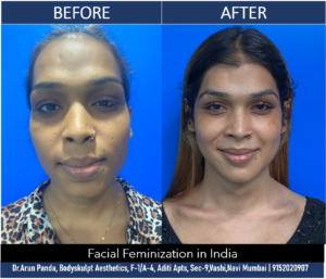 Read more about the article Facial Feminization Surgery in India by Top Facial Plastic Surgeon