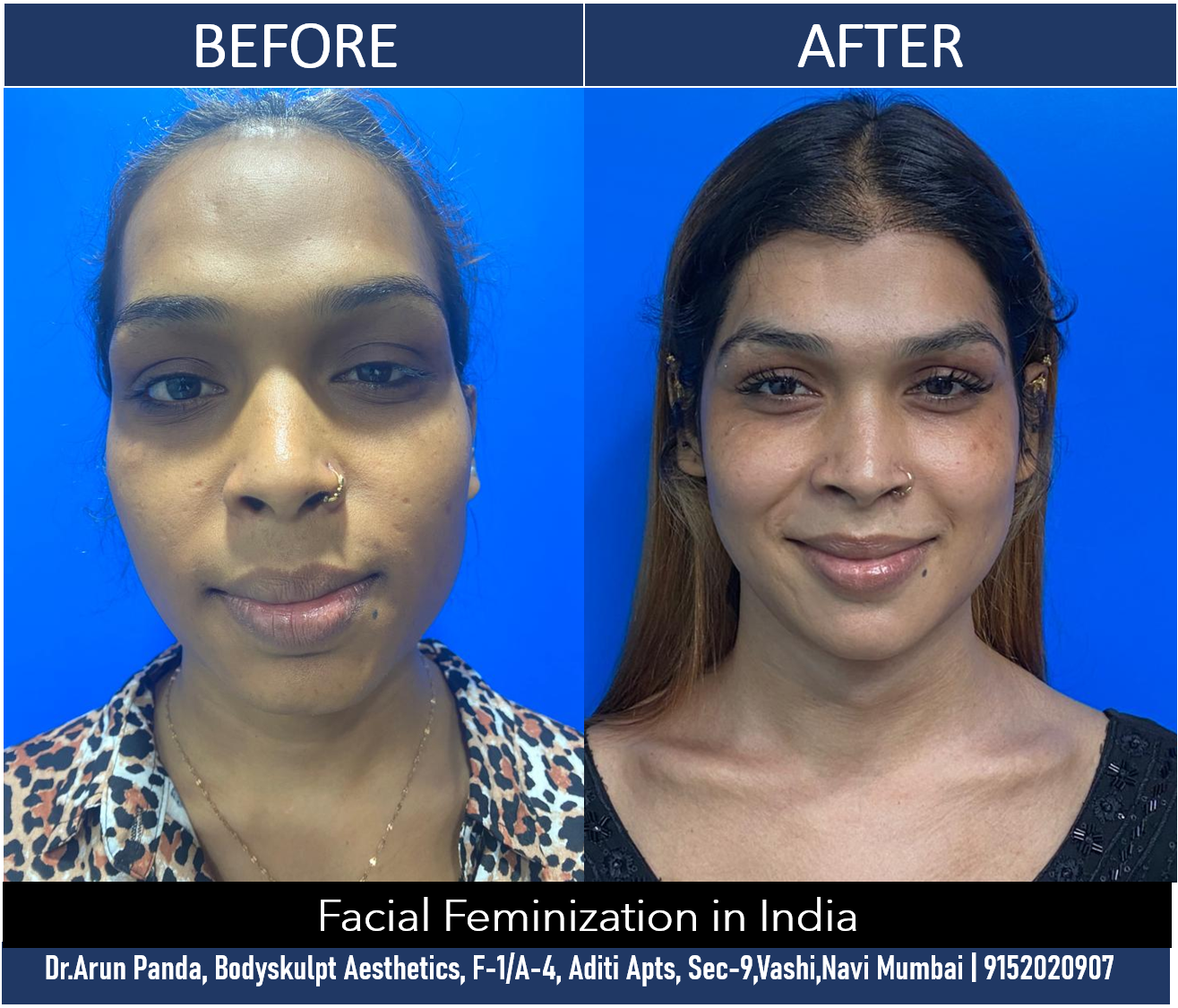 You are currently viewing Facial Feminization Surgery in India by Top Facial Plastic Surgeon