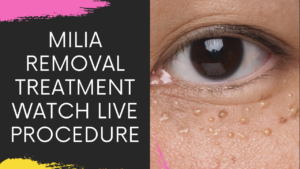 Read more about the article Milia Removal Treatments In Navi Mumbai | Milia Eyelid | Milia Eyelash | Milia Face Treatment