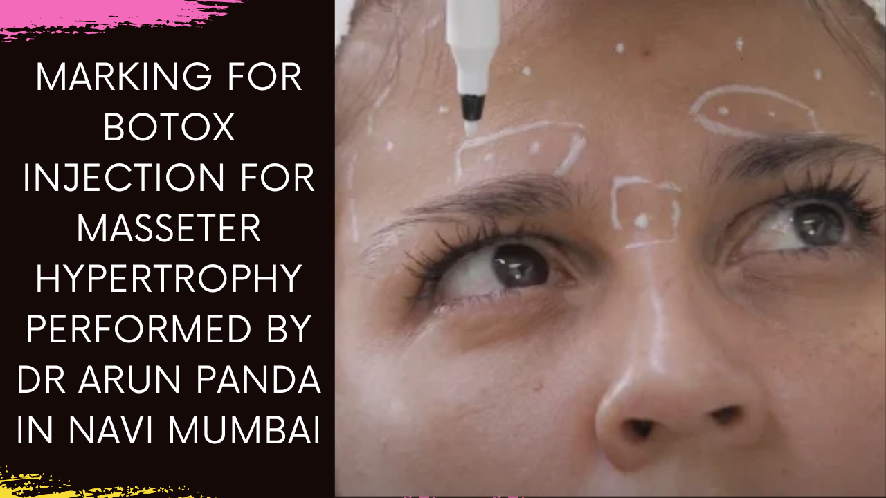 Read more about the article Mastering Masseter Hypertrophy: Botox Injection by Dr. Arun Panda in Navi Mumbai