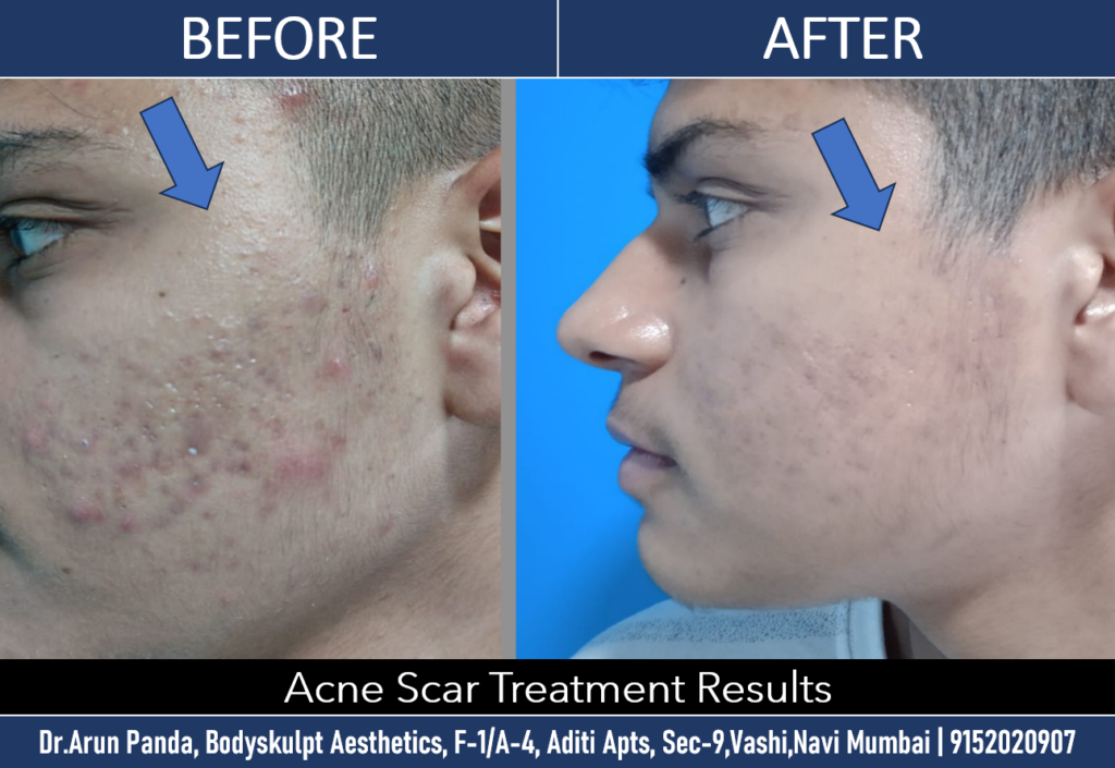 Top-rated acne and scar treatment in Navi Mumbai for visibly clearer, smoother skin.
