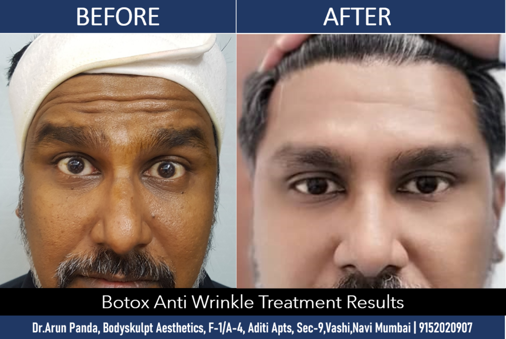 Botox wrinkle removal treatment in Navi Mumbai for smooth, youthful skin.