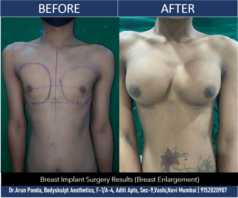 Before and after images of breast augmentation surgery at Bodyskulpt Aesthetics, Navi Mumbai.