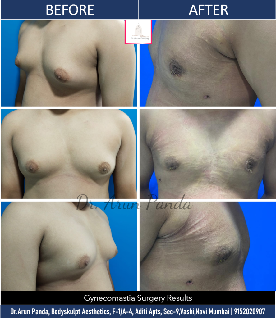 Confidence Restored: Gynecomastia treatment in Navi Mumbai