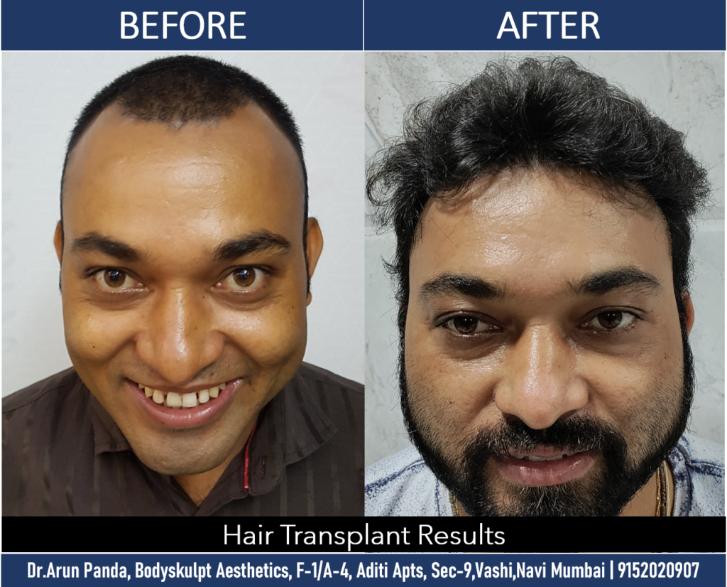 Transformative Hair Transplant in Navi Mumbai by Dr. Arun Panda