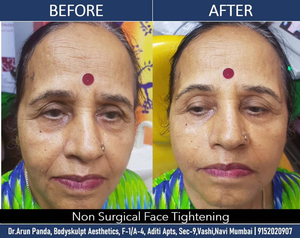 Non-surgical skin tightening treatment options in Navi Mumbai for youthful and firm skin.
