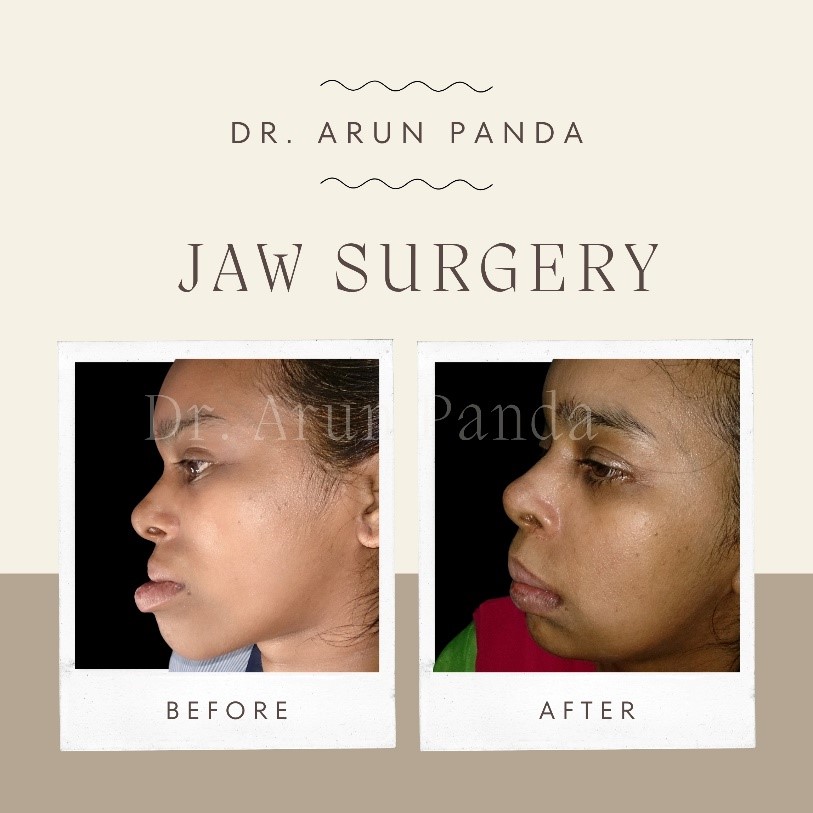 Results of orthognathic surgery in Mumbai