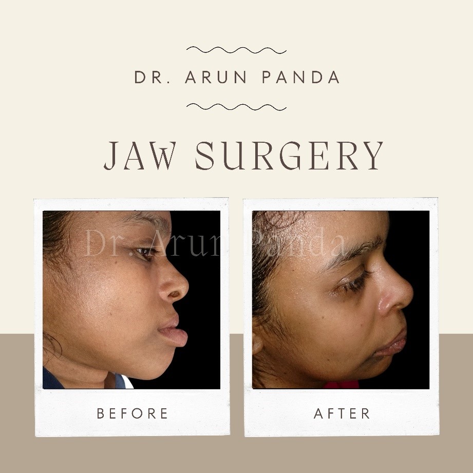 Before and After Results of orthognathic surgery in Mumbai,India