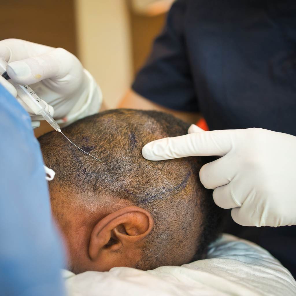 FUE (Follicular Unit Extraction)​