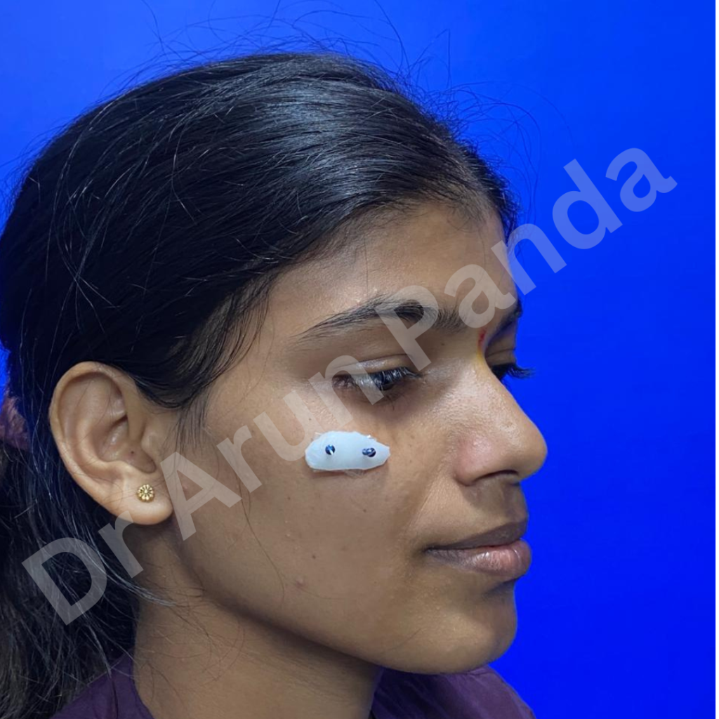 A close-up image of a patient's face with subtle, natural-looking cheek implants, enhancing the facial contours.