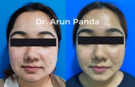 Side-by-side before and after images of a patient who underwent buccal fat removal surgery, highlighting a slimmer face and sharper jawline.