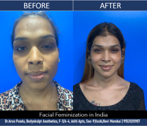 Read more about the article Facial Feminization Surgery in Mumbai, India of a Transgender Patient
