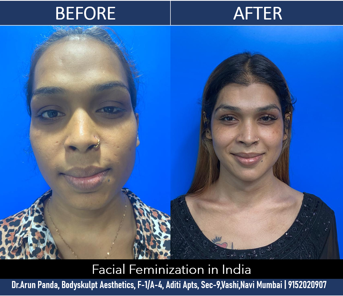 Read more about the article Facial Feminization Surgery in Mumbai, India of a Transgender Patient